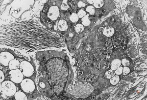 M,40y. | granular cell tumor